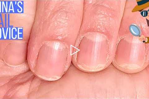 Peeling Nails Common Causes [ANNA'S NAIL ADVICE]