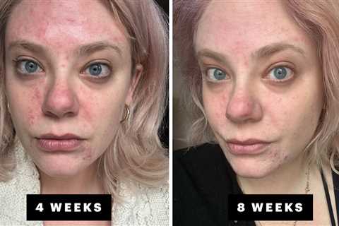 My Hormonal Acne Journey With Winlevi, the New Spironolactone Alternative for Treating Hormonal and ..