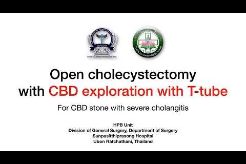 Open Cholecystectomy with CBD exploration for CBD stone+cholangitis; in case of unsuccessful ERCP.